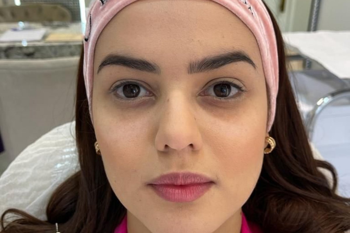 Eslovênia do BBB22 realiza harmonização facial. Veja antes e depois  