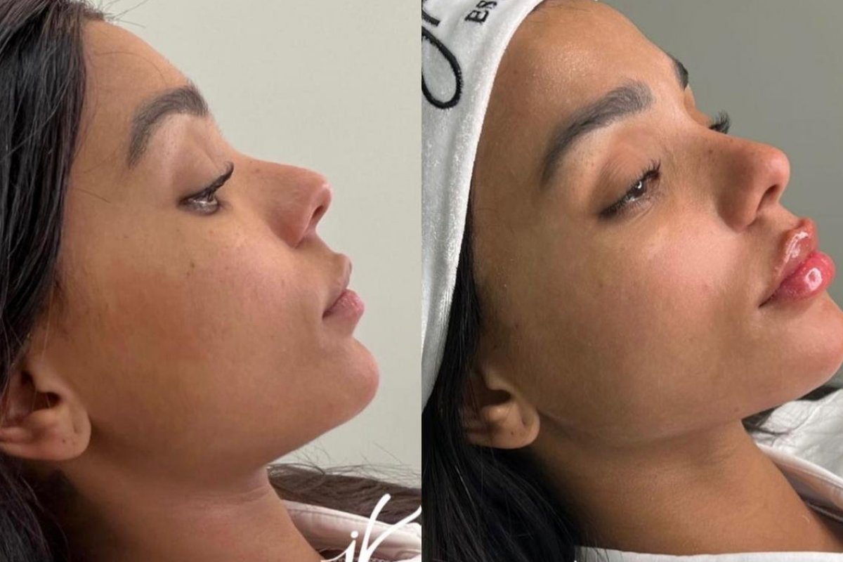 Bruna Gonçalves retoca harmonização facial e aumenta os lábios. Confira o antes e depois! 