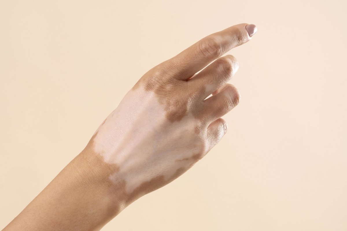 Com causa indefinida, vitiligo atinge cerca de 1 milhão de brasileiros  
