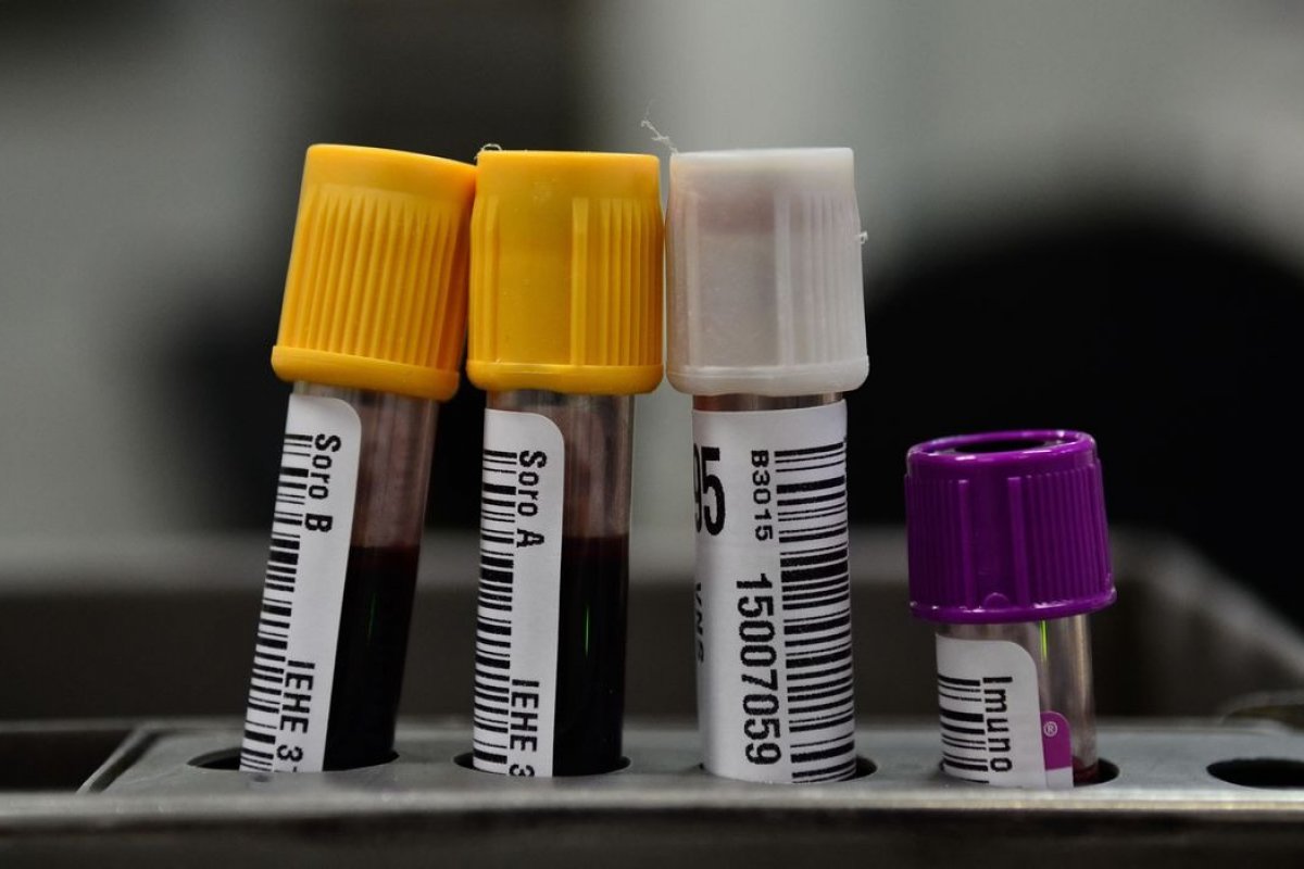 Exame que detecta Alzheimer por meio de amostra de sangue chega ao Brasil