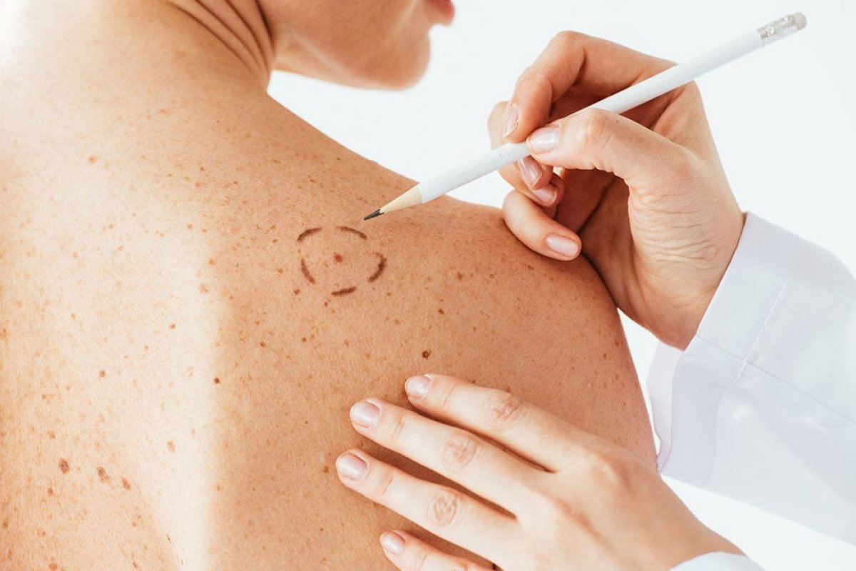 Junho Preto alerta para o melanoma, câncer de pele mais agressivo! 
