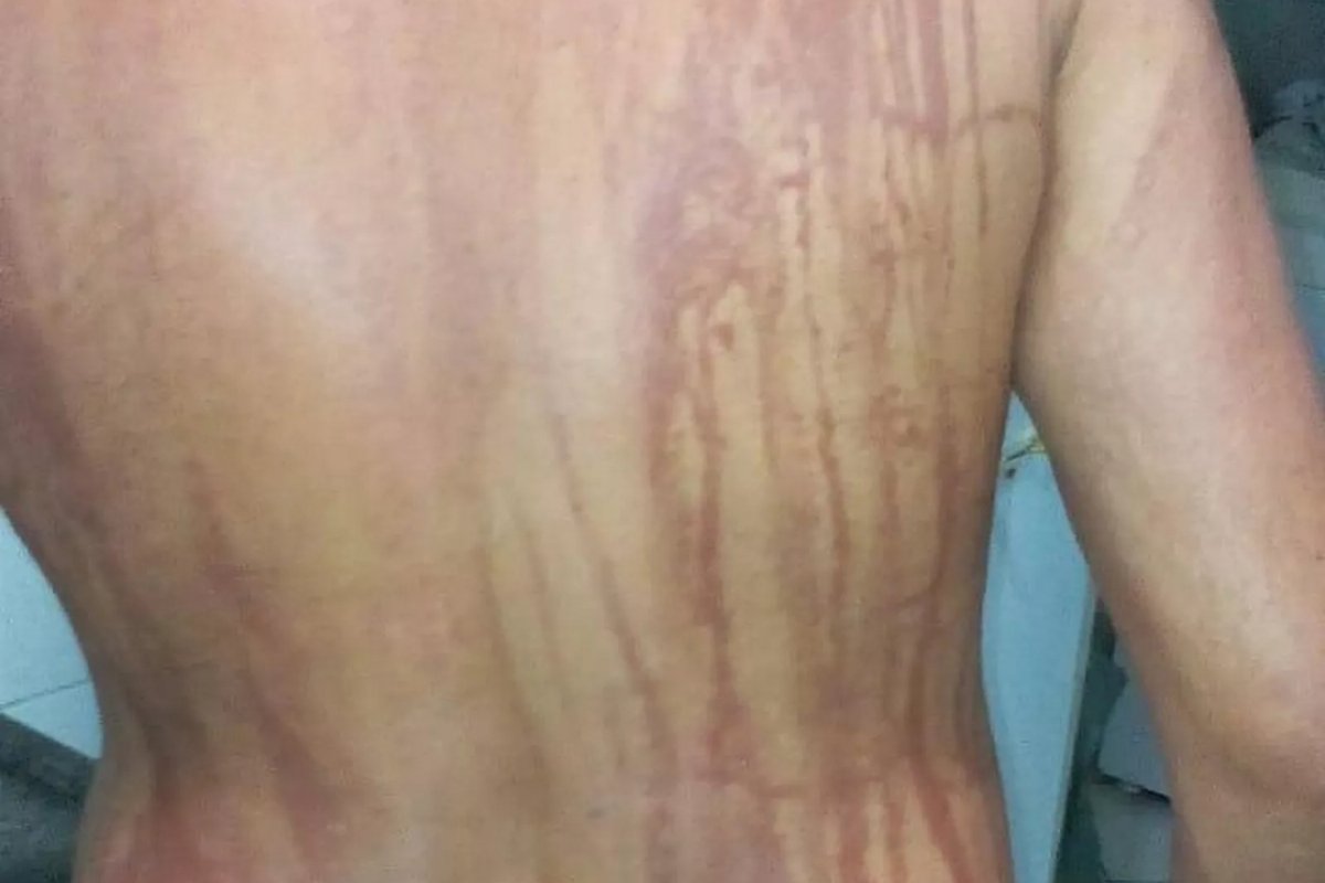 Após tomar banho de mar em Ilhéus, homem fica com o corpo manchado 