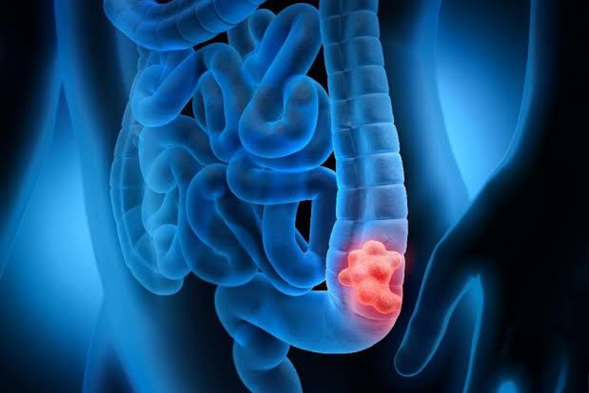 Alterações de hábitos intestinais e presença de sangue nas fezes são sinais de alerta para o câncer anal 