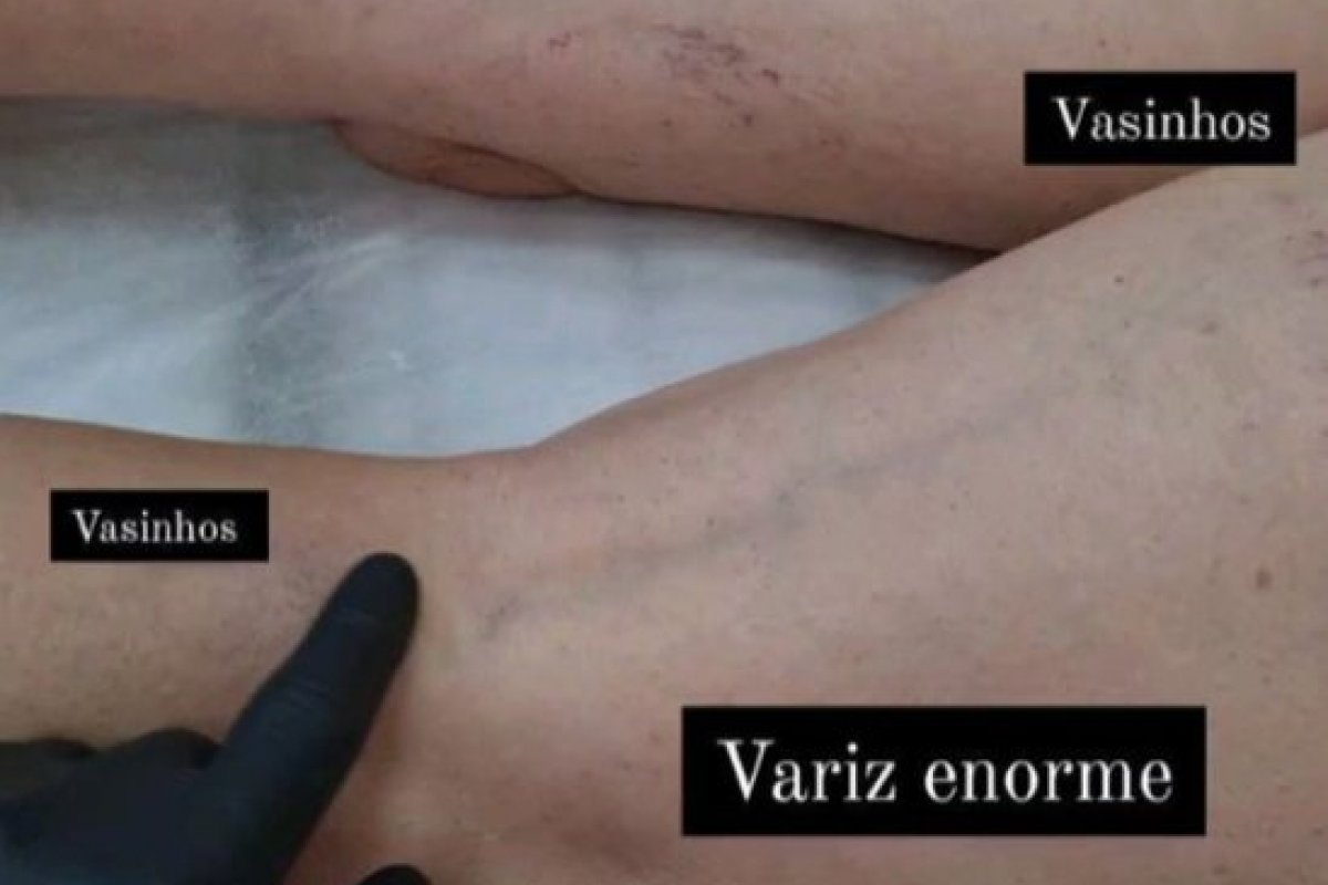 15 de agosto: Dia da Consciência Vascular - Varizes não tratadas podem levar a sérios problemas de saúde  