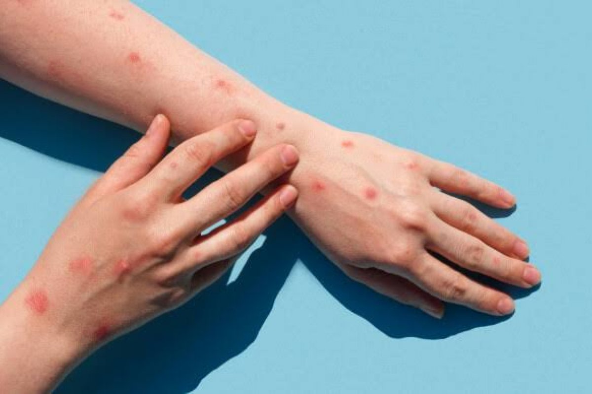 Brasil registra a terceira morte por monkeypox