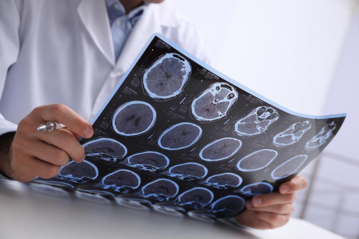 Cientistas encontram genes que modulam o envelhecimento cerebral, revela estudo