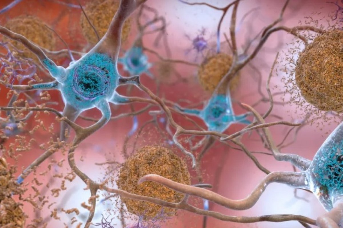 Medicamento experimental consegue retardar progressão do Alzheimer, aponta estudo