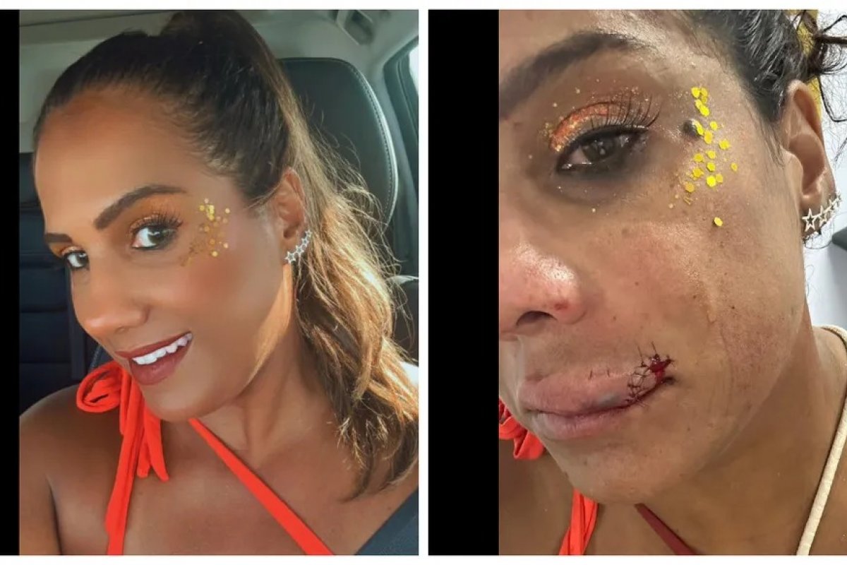 Carnaval de Salvador: mulher de 44 anos denuncia ter sido agredida com murro na boca