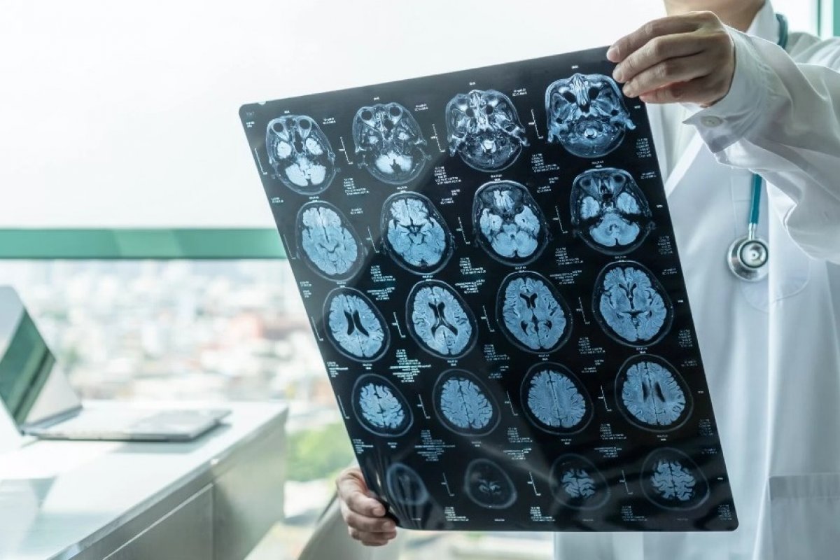 Chinês de 19 anos pode ser pessoa mais jovem com Alzheimer, diz pesquisa