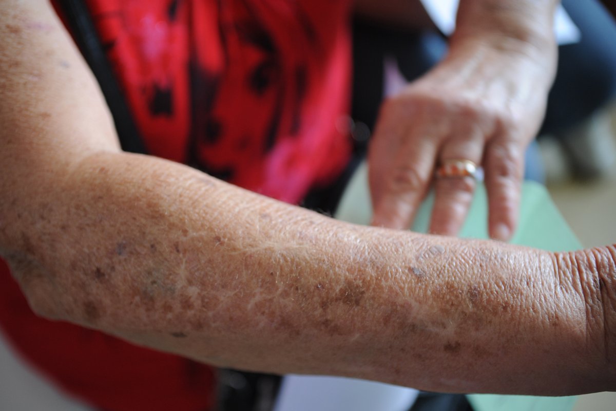 Hospitais realizam mutirão de atendimento para prevenção do câncer de pele 
