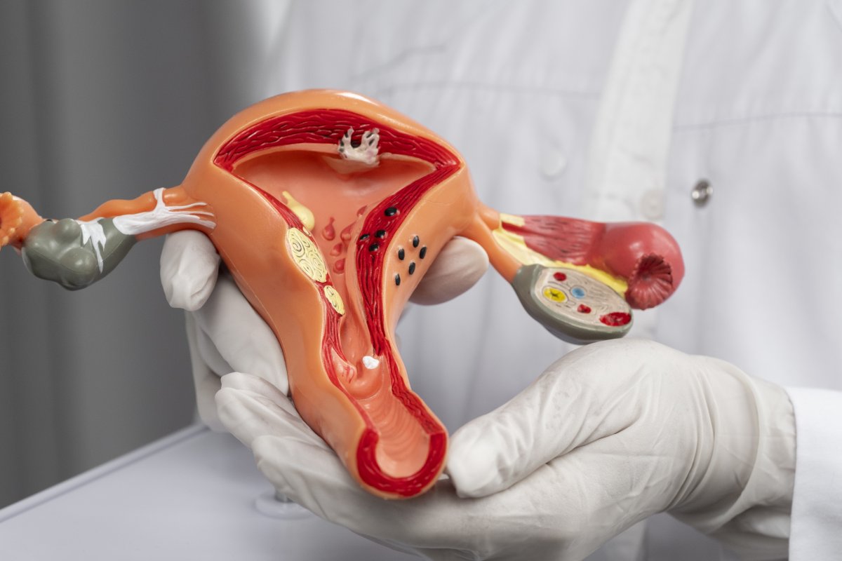 Demora no diagnóstico afeta qualidade de vida de mulheres com endometriose!