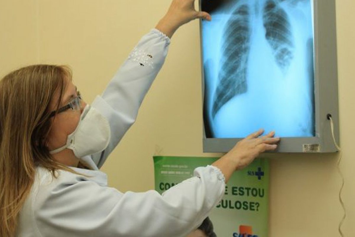 Tuberculose causou 5 mil mortes em 2021 no Brasil 