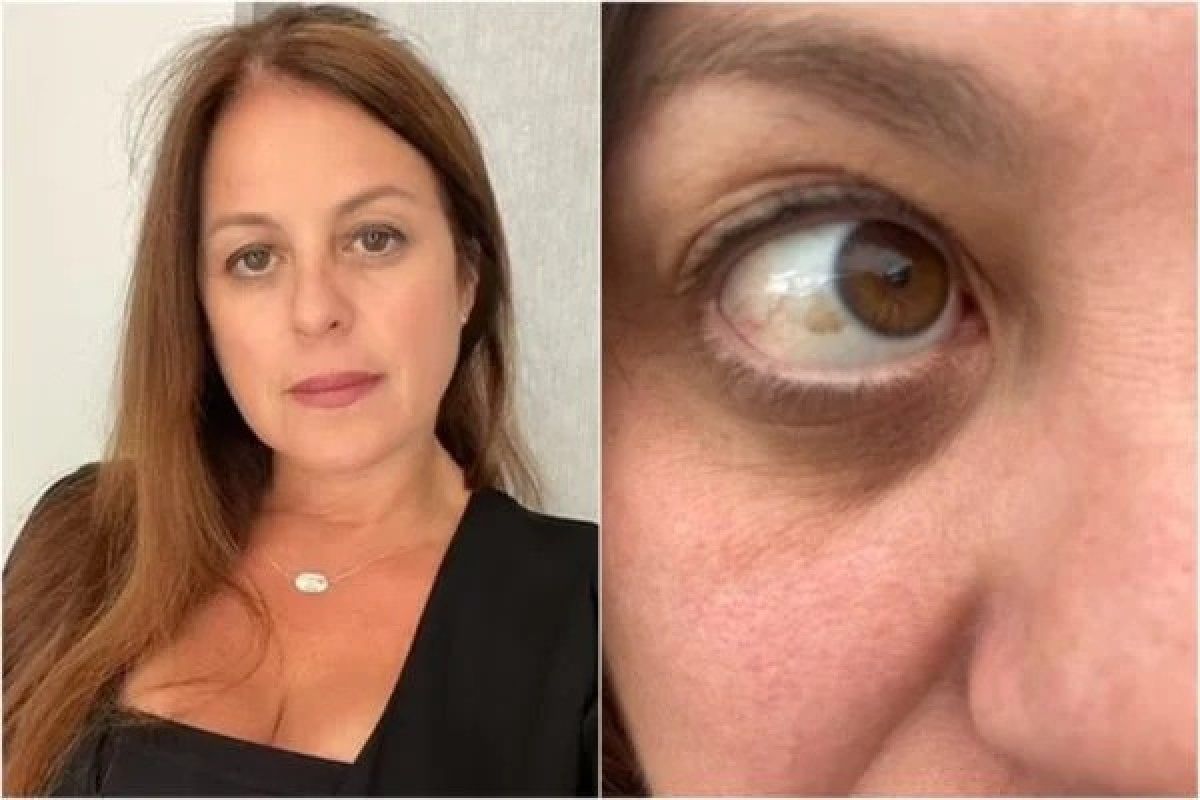 Americana de 47 anos fica cega por algumas horas após queimadura de sol nos olhos