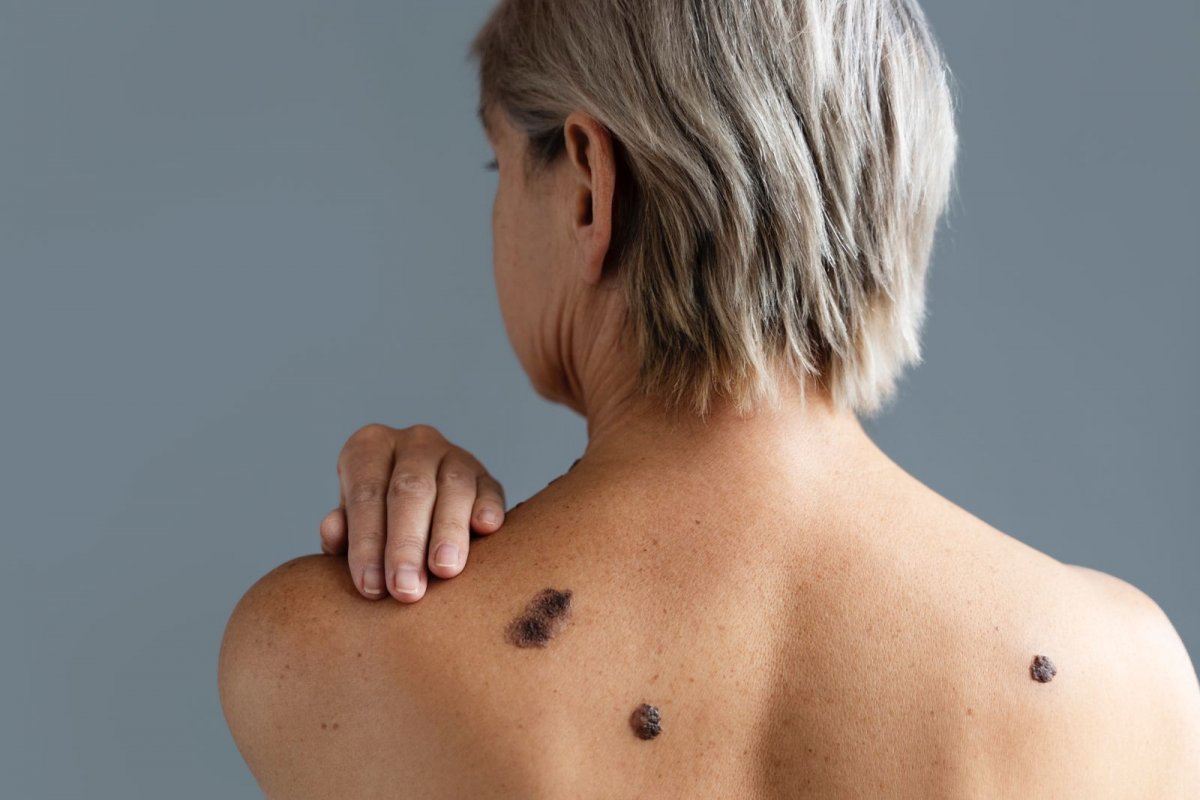 Médicas dermatologistas explicam quais são os tipos de câncer de pele e como tratá-los! 