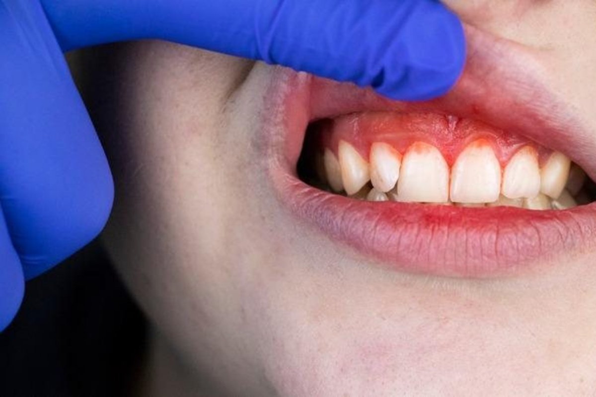 Inflamação na gengiva: tratamento adequado é necessário para evitar problemas mais graves!   