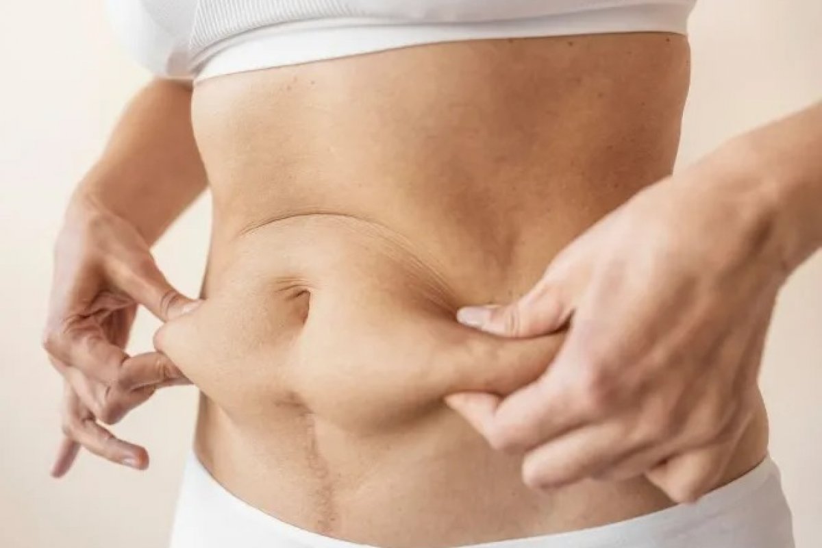 Mioesteatose: a infiltração de gordura nos músculos que pode ser tão perigosa quanto a obesidade