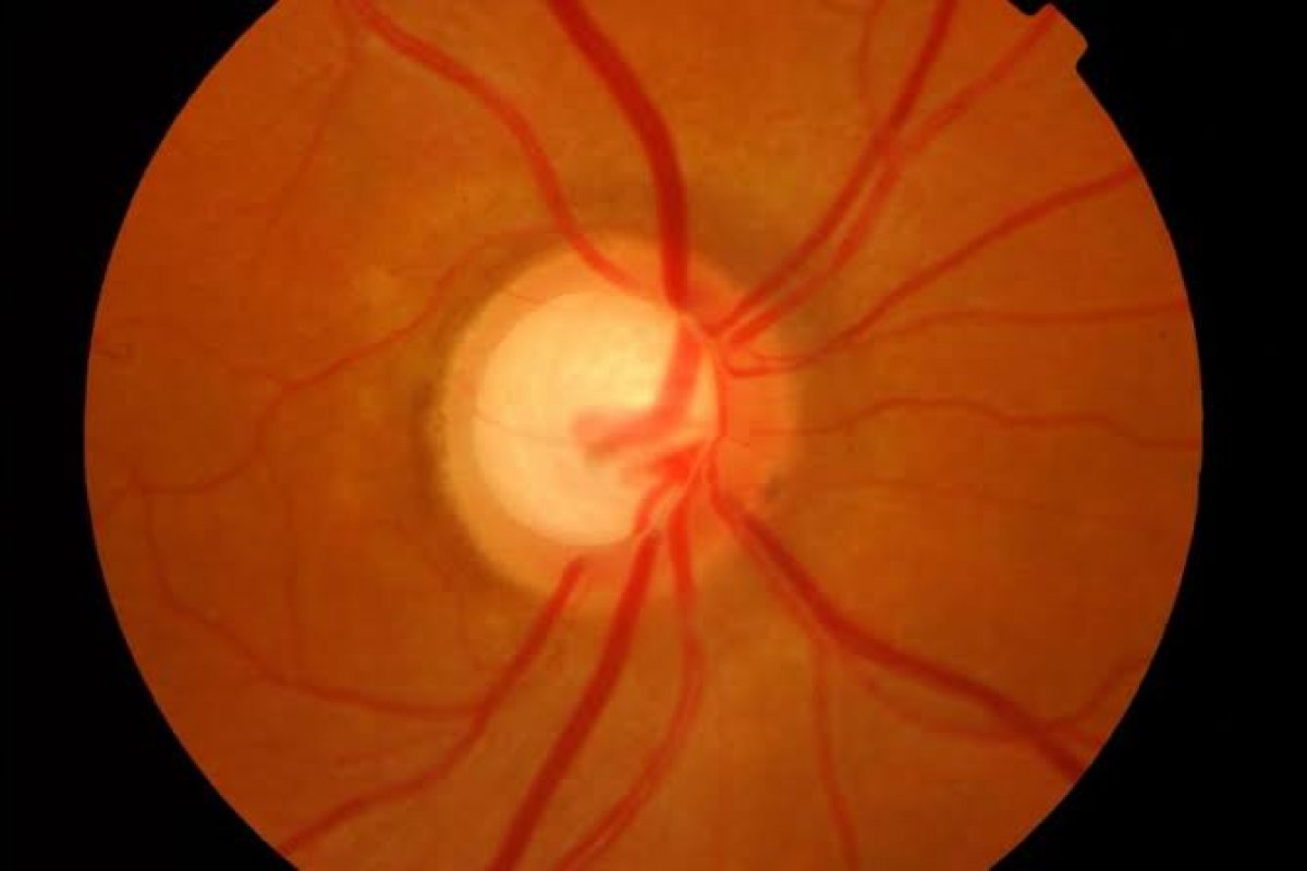 Citicolina é capaz de reduzir a progressão do glaucoma! 