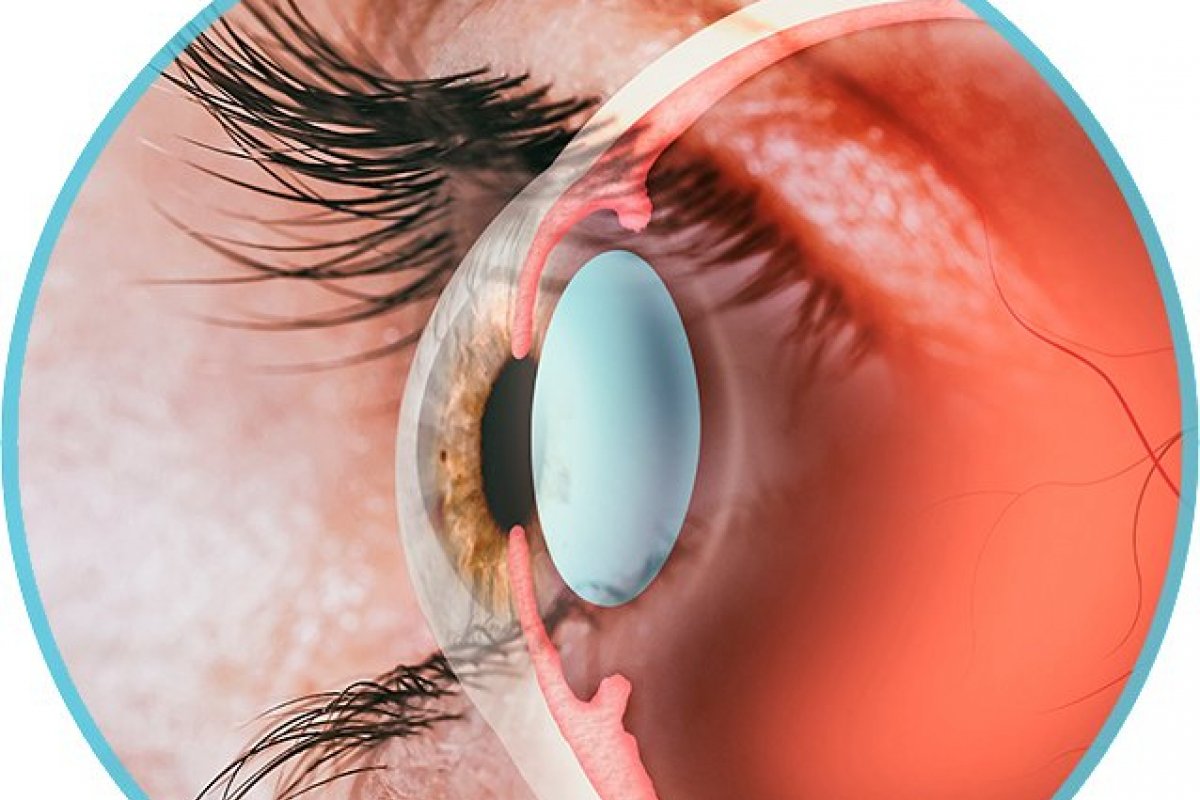 Taxa elevada de gordura no sangue aumenta risco de glaucoma, aponta estudo  