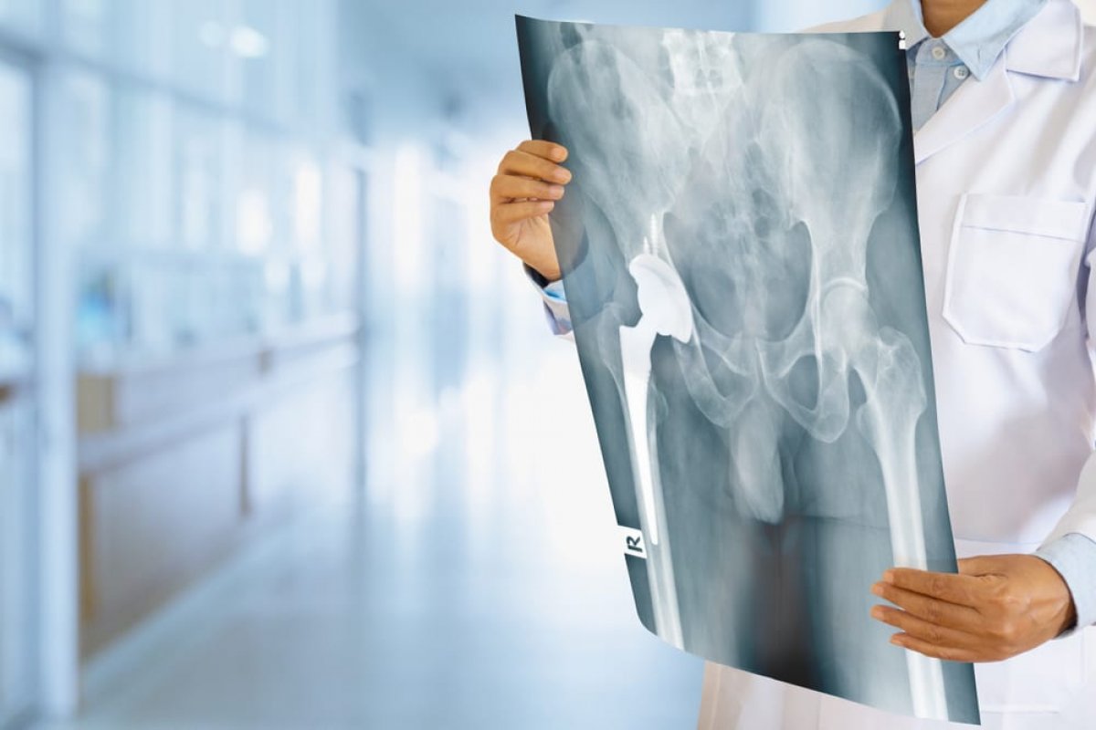 Cirurgia do quadril: entenda como funciona o procedimento realizado pelo Presidente da República!