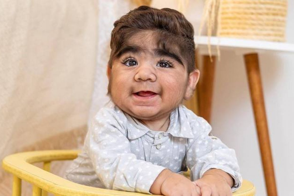 Bebê peludo brasileiro viraliza nas redes sociais por causa de condição rara