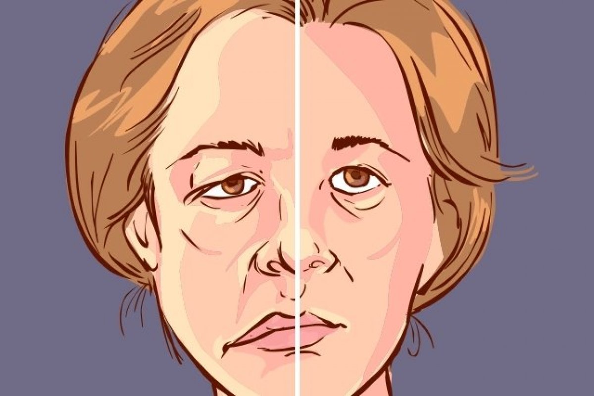 Paralisia facial: por que (e quando) acontece?   