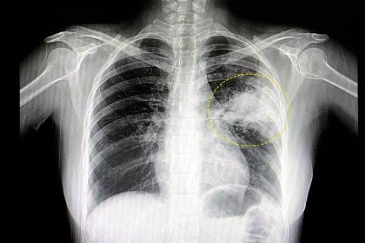 Bahia já teve mais de 2,3 mil mortes por pneumonia em 2023! 