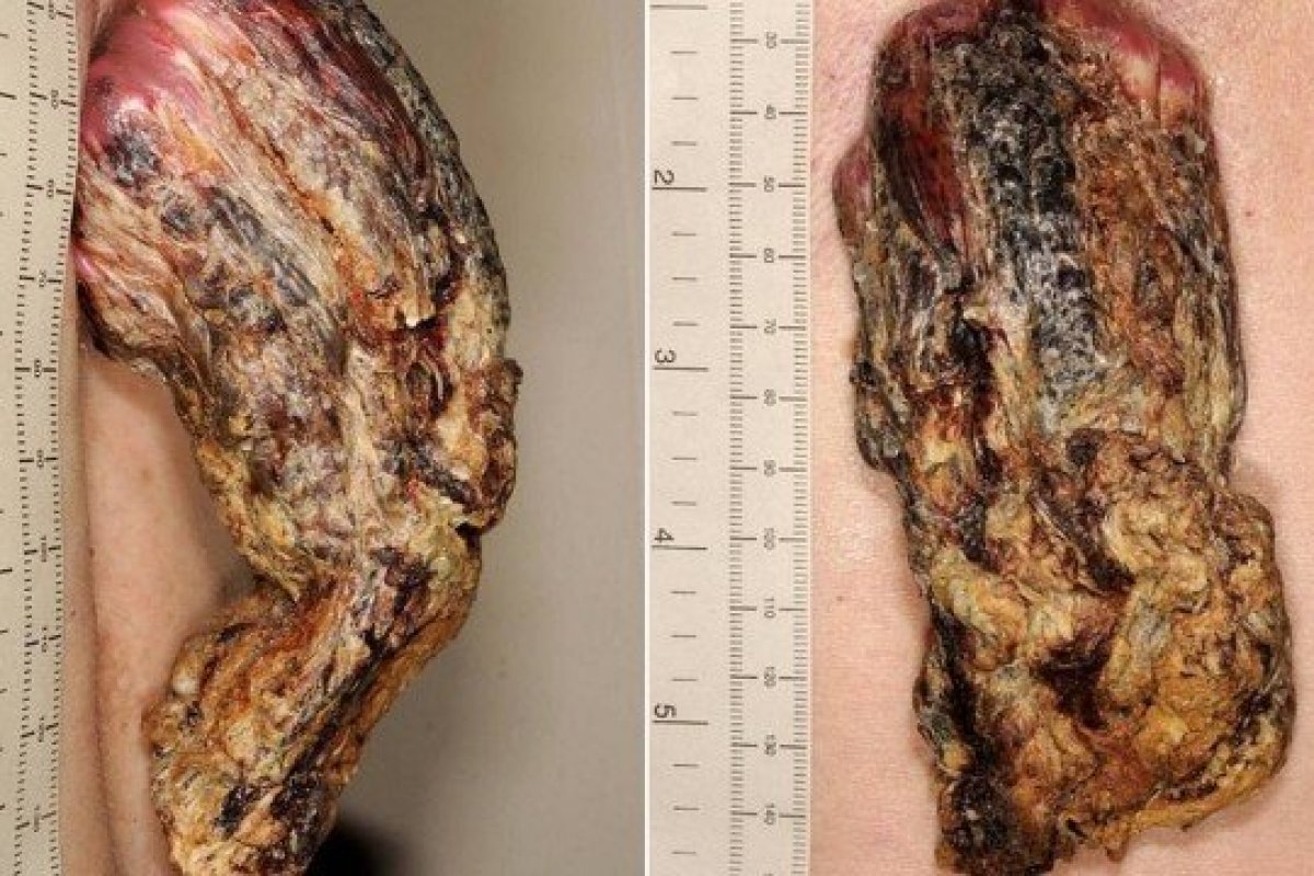 "Chifre" de 14cm é retirado das costas de um homem na Inglaterra