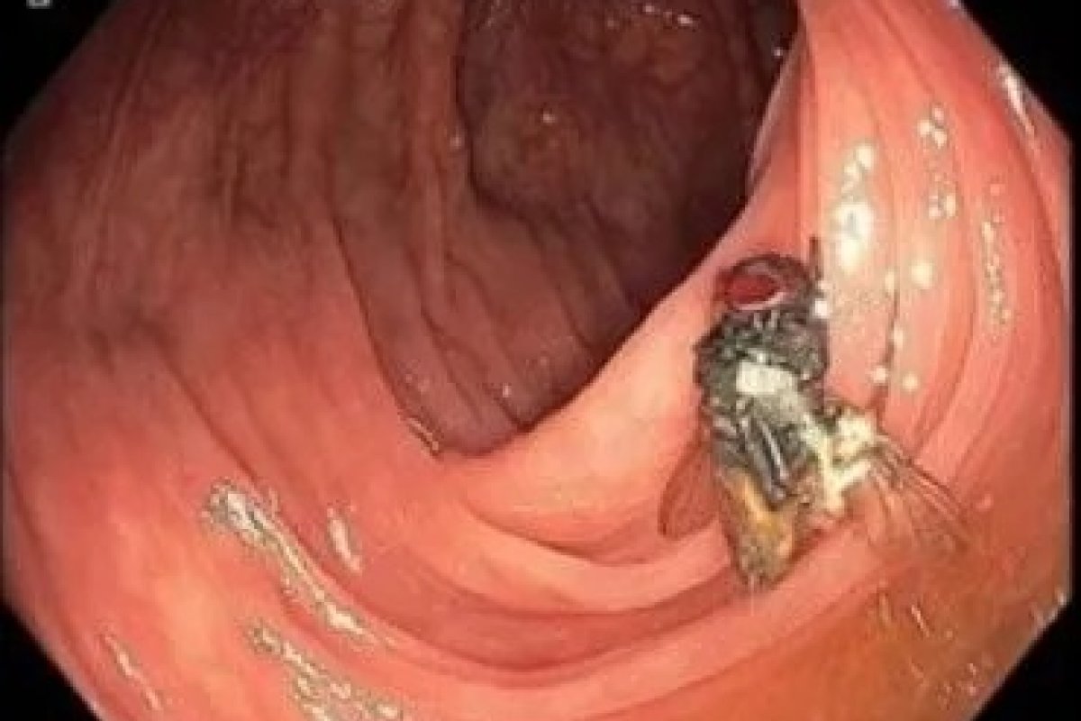 Médicos encontram mosca viva dentro de intestino de paciente nos Estados Unidos 