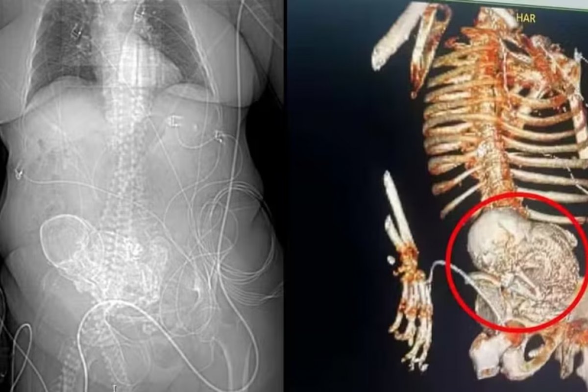 Família de indígena morta após cirurgia autoriza pesquisa com feto calcificado