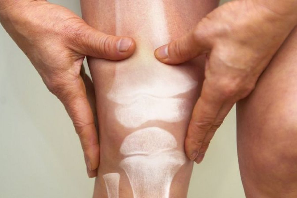 Pesquisa aponta que osteoporose causa mais de 8,9 milhões de fraturas por ano