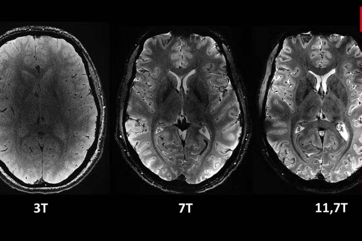 Novo scanner de ressonância magnética revela detalhes do cérebro humano