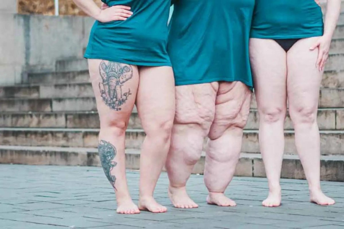 Médicos alertam para risco de distúrbio na menopausa causado pela lipedema! 