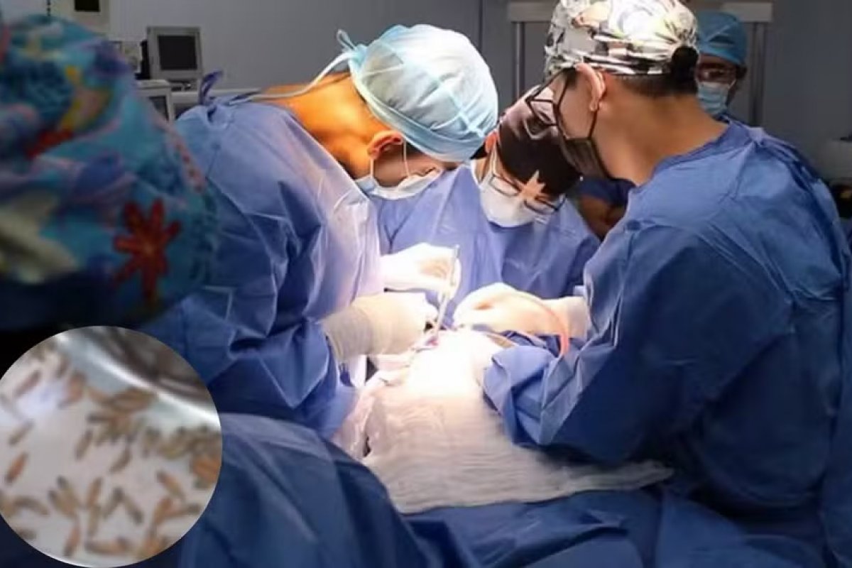 Médicos encontram 150 larvas 'morando' na boca de uma mulher no Peru 