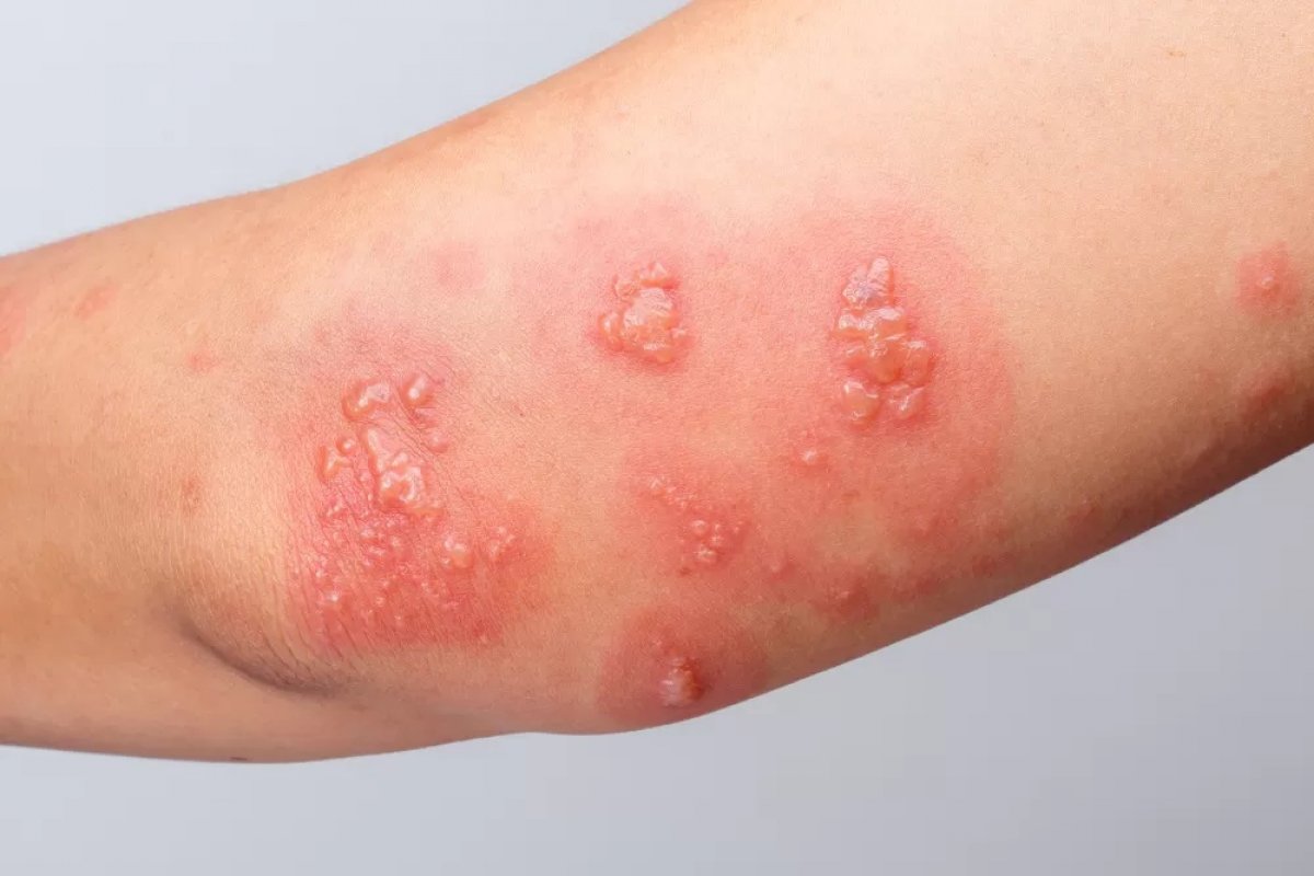 Reativação do vírus da catapora, herpes-zóster afeta principalmente idosos