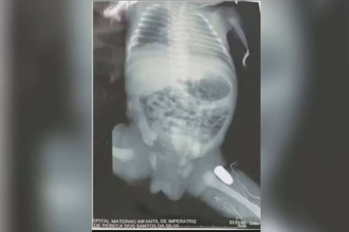 Adolescente grávida é baleada e projétil fica alojado em perna do bebê no MA