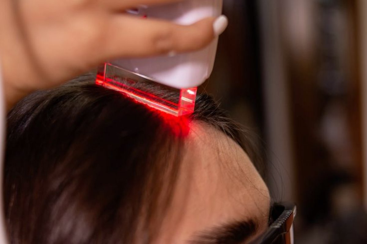 Dra. Luciana Passoni explica como funciona o tratamento de queda capilar com laser! 