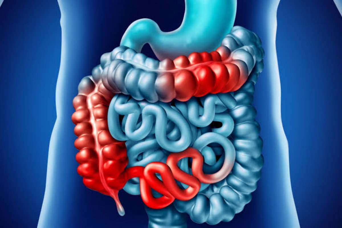 Doença de Crohn afeta 5 milhões de pessoas no mundo e pode prejudicar a gravidez e a qualidade do sêmen! 