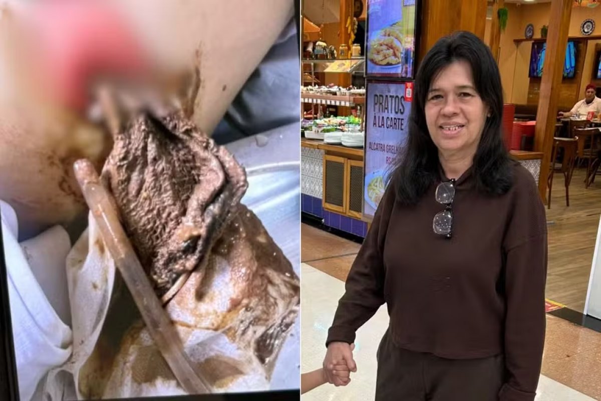 Mulher descobre que ficou com pano na barriga dois anos após cirurgia no intestino 