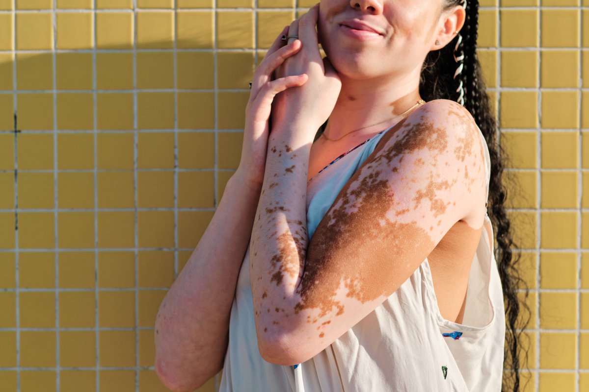 Vitiligo: doença que afeta mais de 1 milhão de brasileiros tem cura?  