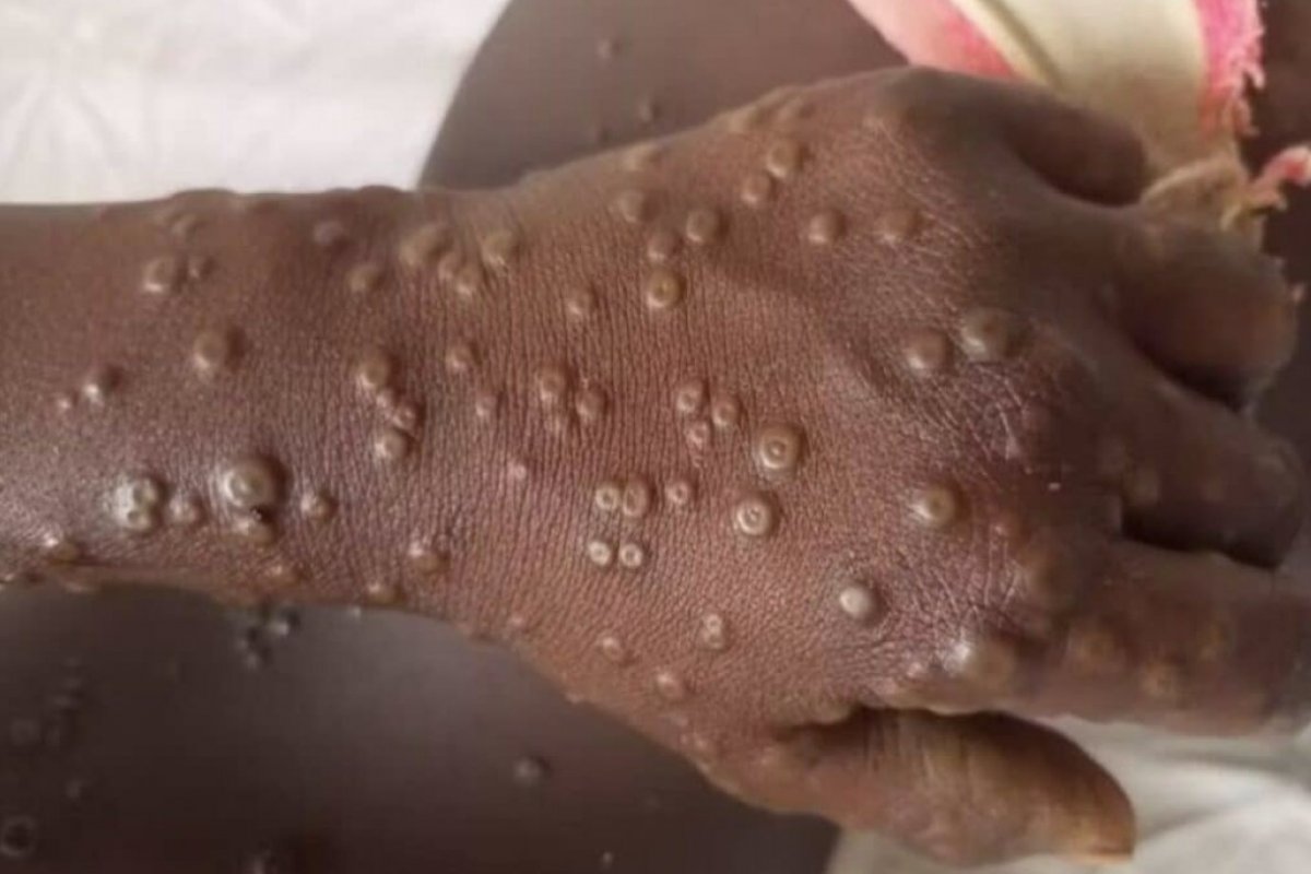 Suspeita de Caso de Mpox entre Imigrantes é registrado no aeroporto de Guarulhos