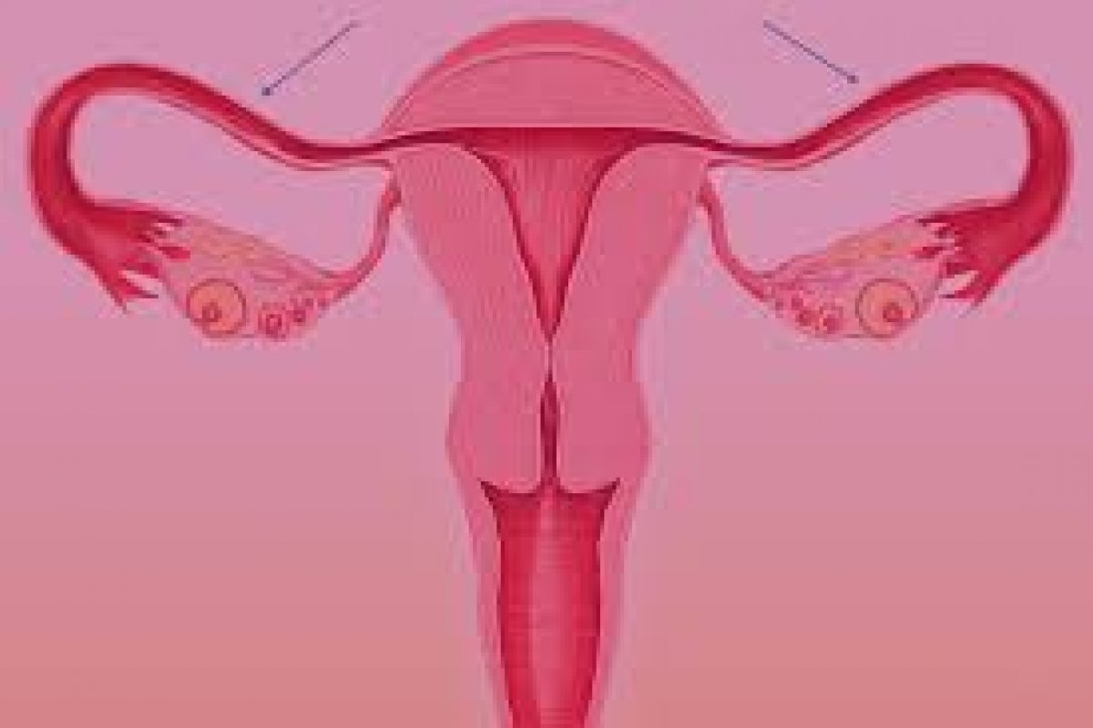 Saúde das trompas: entenda a hidrossalpinge, obstrução que pode causar infertilidade!