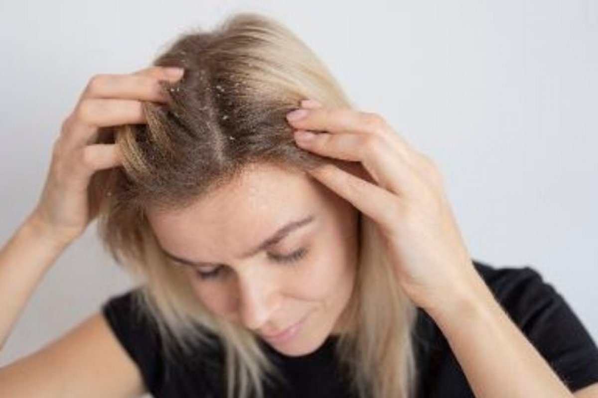 Confira 5 dicas para acabar com as caspas no cabelo! 
