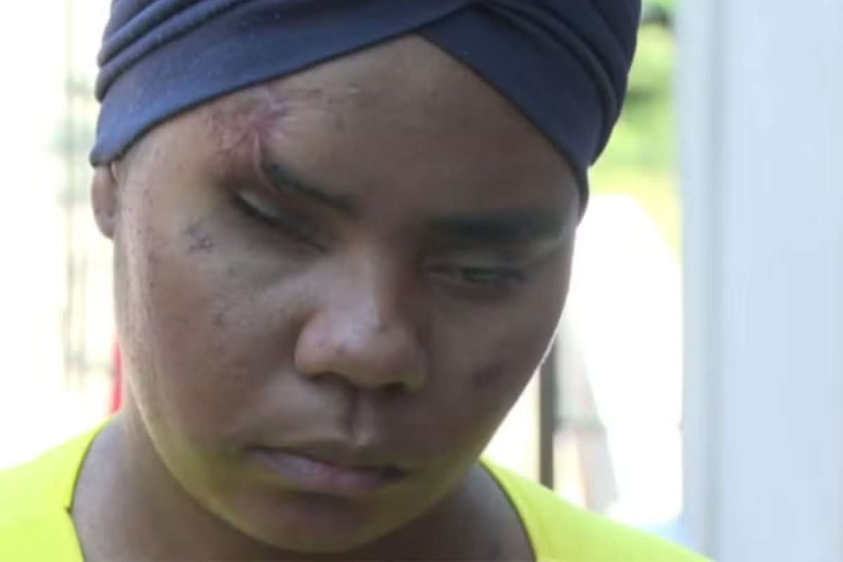 'Estou tentando viver', diz jovem que perdeu visão de um dos olhos após ser feita refém em Salvador