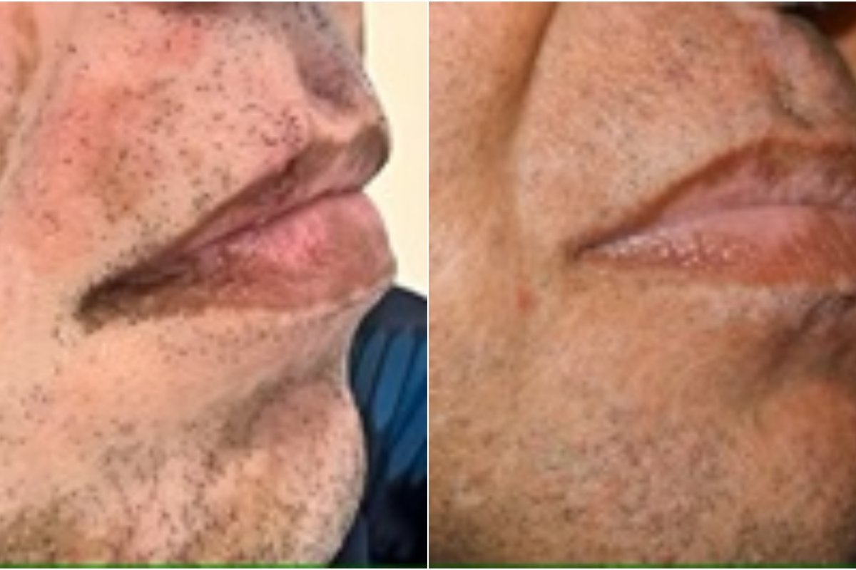 Homem com 98% do corpo coberto por vitiligo se recupera da doença após divórcio 