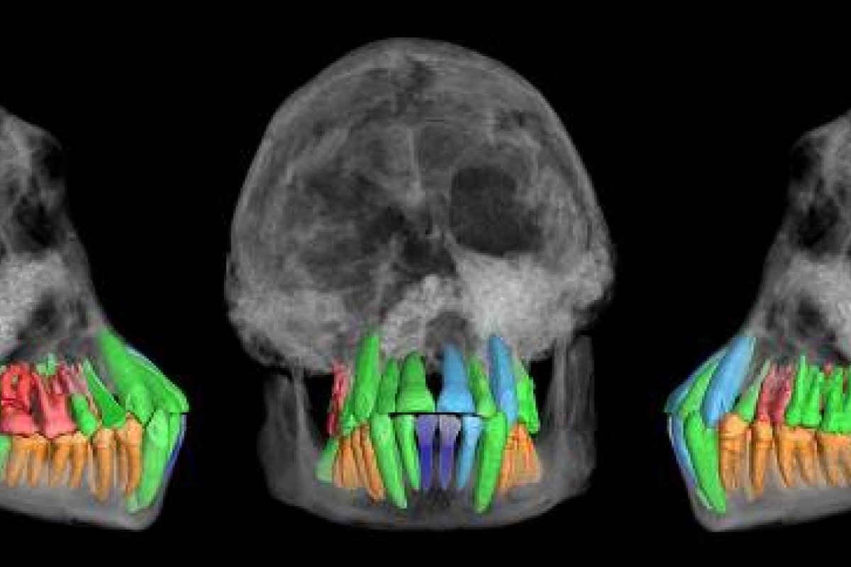 Dentes de adolescente de 1,8 milhão de anos mostram pistas de evolução do crescimento humano