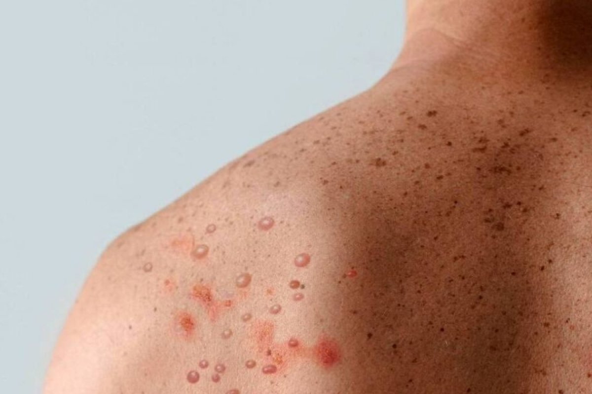Variante da MPOX tem primeiro caso confirmado nos Estados Unidos 