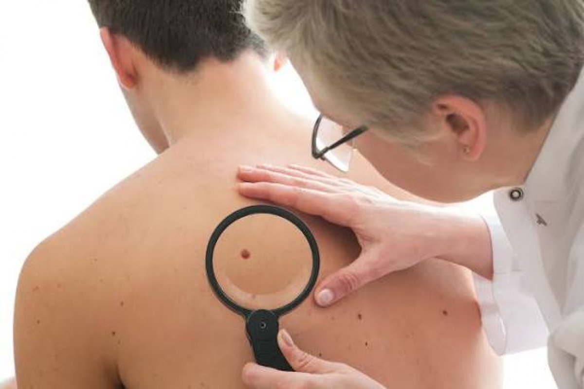 Câncer de pele tem mais incidência entre homens do que o câncer de próstata no Brasil!