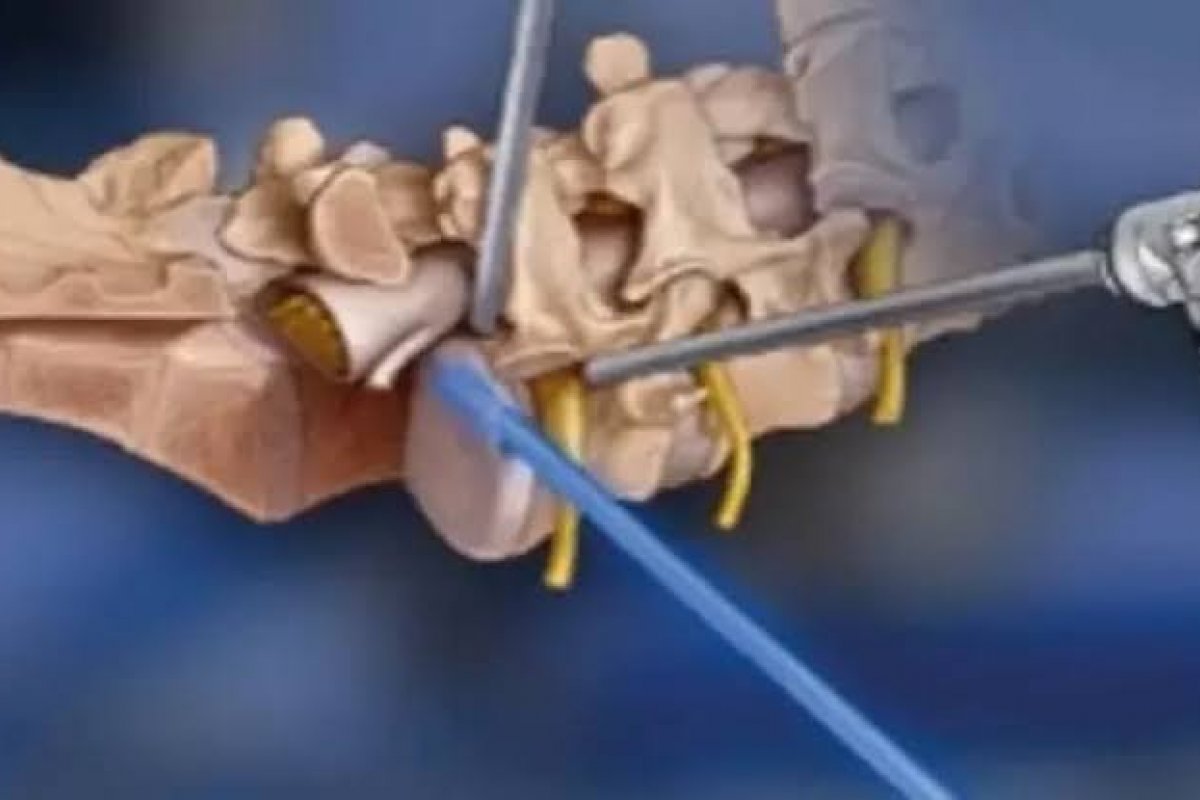 Cirurgia endoscópica da coluna avança como alternativa menos invasiva para dor crônica!