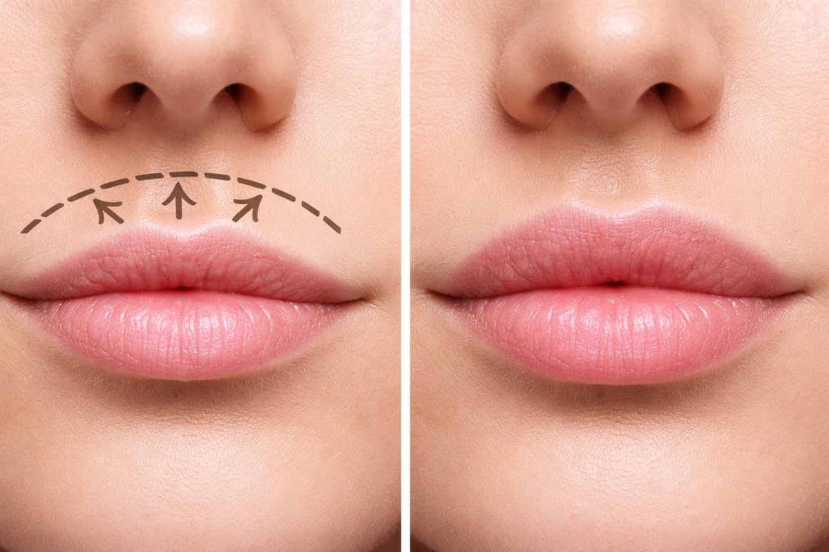 Cirurgião baiano explica o Lip Lift - técnica que reposiciona o sorriso e transforma sem exageros!   