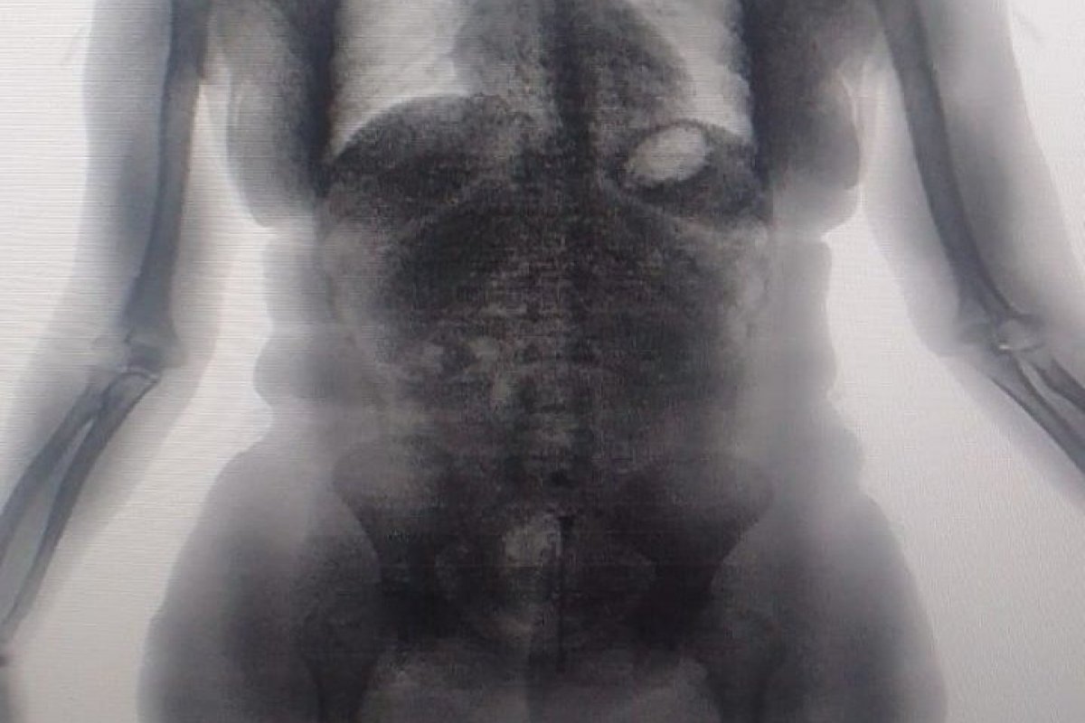 Visitante é flagrada pelo BodyScan tentando entrar com drogas escondidas em presídio na RMS
